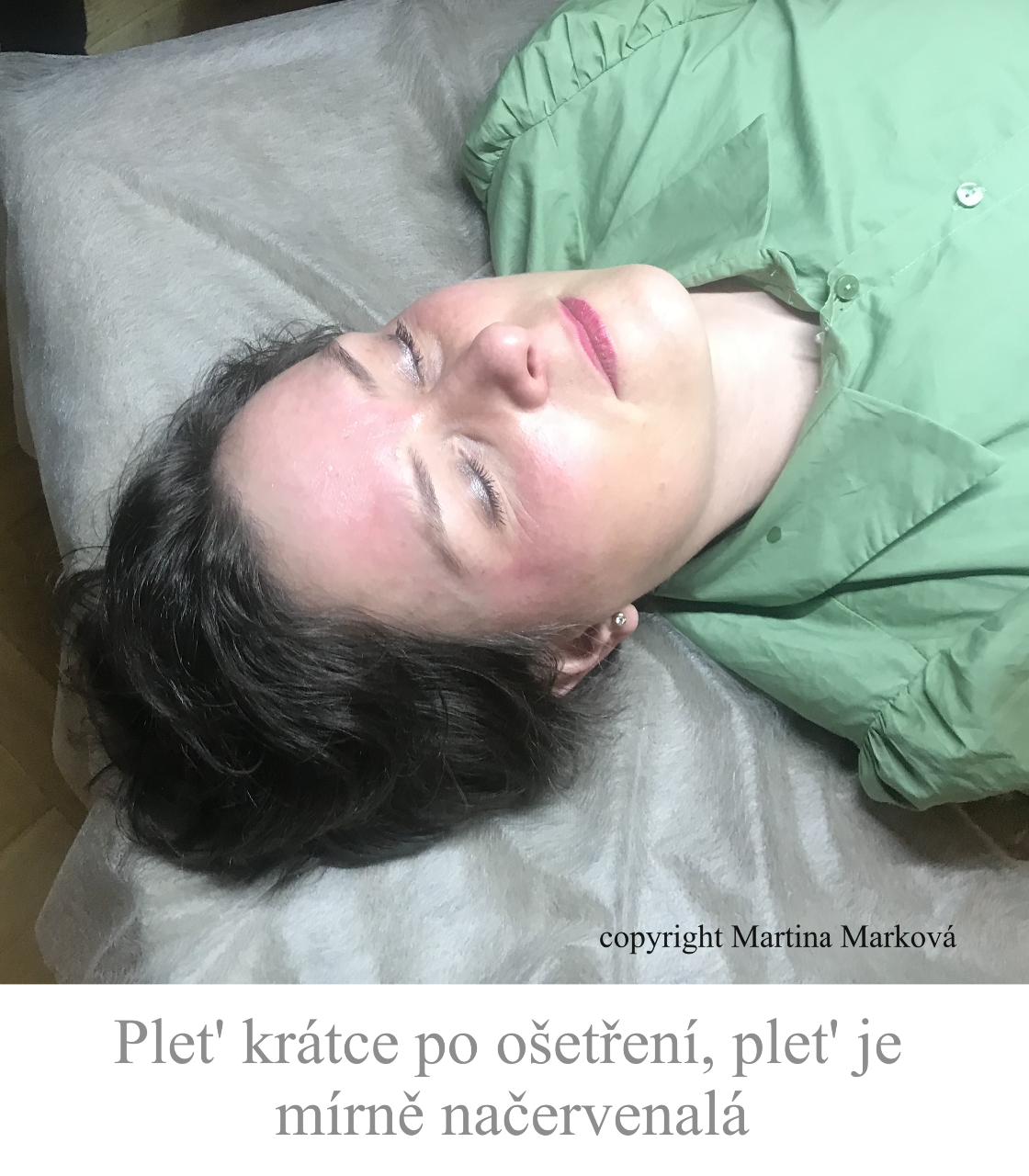 lifting obličeje Brno
